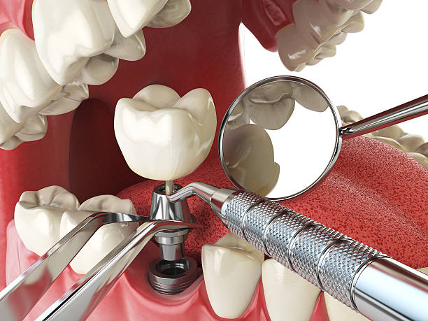 Best Emergency Broken Tooth Repair in Webster City, IA